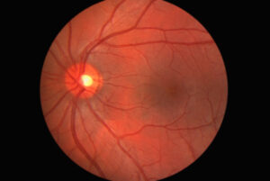 Photo of the human eye's retina
